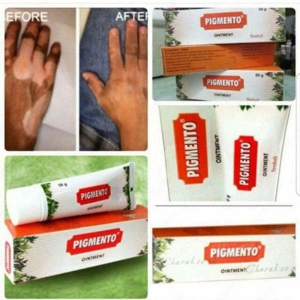 Krem Rigmento dlya lecheniya vitiligo