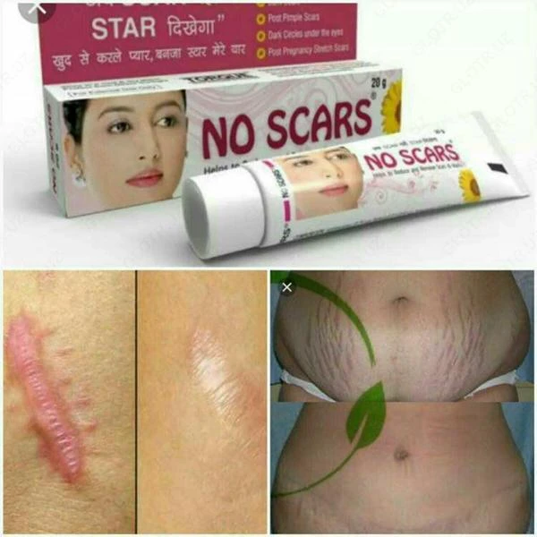 Chandiqlarni olib tashlash kremi Skarsiz