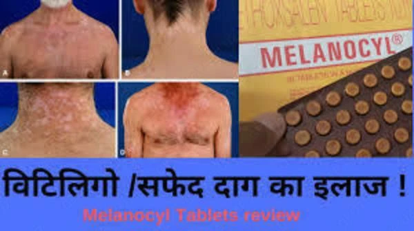 Таблетки Меланоцил (Melanocyl) для лечения витилиго