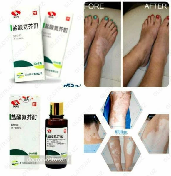 VITILIGO ni davolash uchun damlamasi - Yansuan Danjie Ding