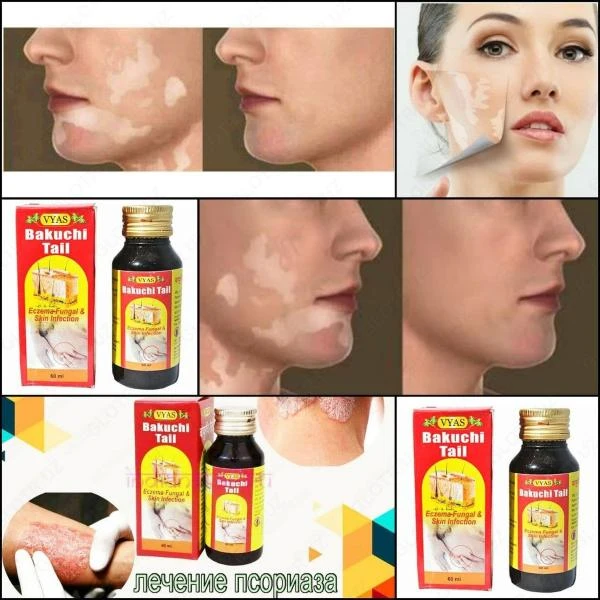 Vitiligo va psoriaz uchun Bakuchi yog'i