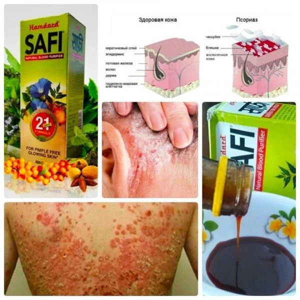 Сафи сироп от псориаз