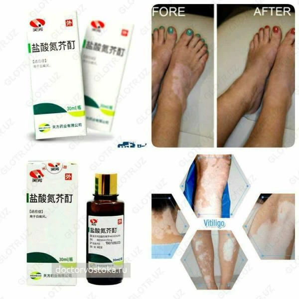 Yansuan Danjie Ding vitiligo davolash uchun damlamasi