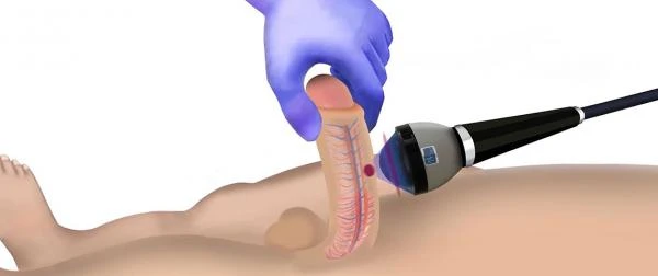 Udarno-volnovaya terapevticheskaya sistema dlya lecheniya erektilnoy disfunksii