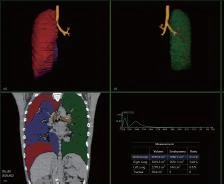 Multispiralniy Kompyuterniy tomograf  model: NeuViz 64