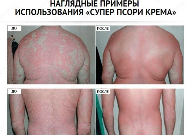 Psoriaz uchun krem Super Psori (100 ml.)