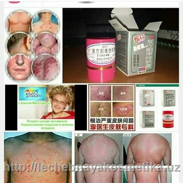 Тайская мазь «Король кожи и псориаза»