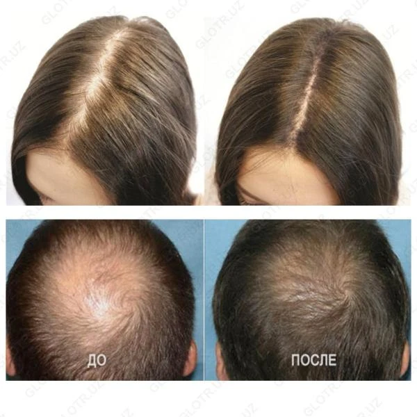 Средство от облысения Minogain 10%