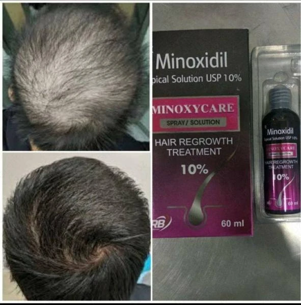 Preparat Minoxidil 10% - 60ml.