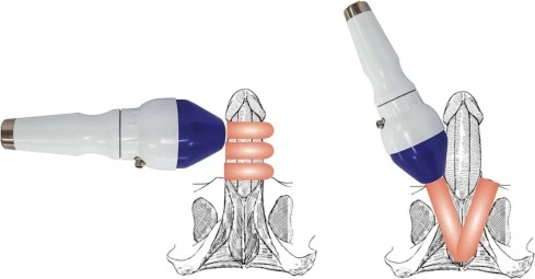 Udarno-volnovaya terapevticheskaya sistema dlya lecheniya erektilnoy disfunksii