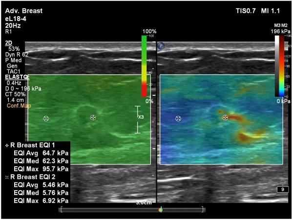 Ультразвуковая система Philips EPIQ Elite
