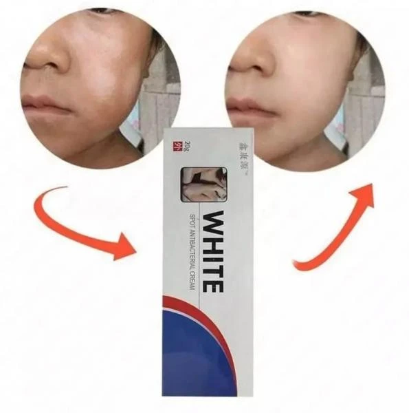 Крем антибактериальный против белых пятен витилиго