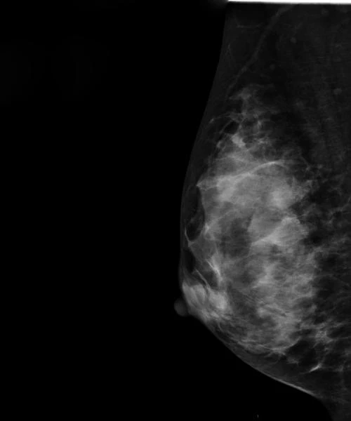 Polnoformatniy Sifrovoy Mammograf LUNA