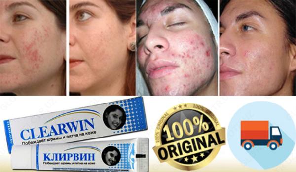 Klirvin krem ot prishey i shramov