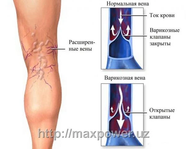 Эластичный чулок от варикоза ниже колена