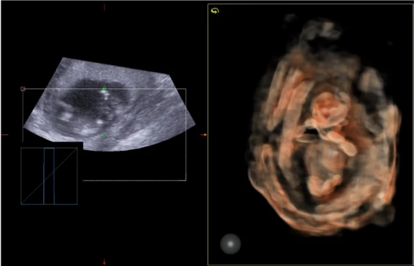Ультразвуковой сканер Esaote MyLab X5