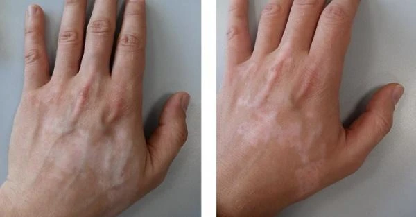 Комплекс специальных восстанавливающих средств для витилиго