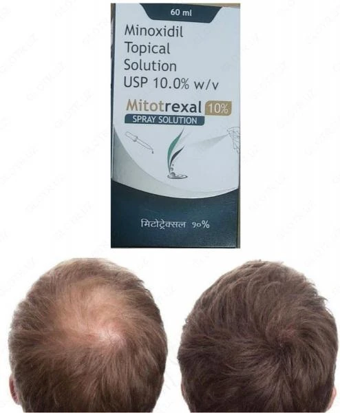 Sochni davolash uchun original mahsulot Minoxidil 10% Topikal eritma (Mitotrexal 10%)
