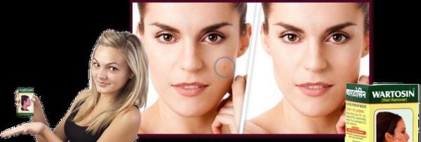 Wartosin - Vartosin (udalenie borodavok)