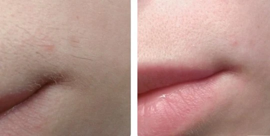 Диодная эпиляция в Ташкенте