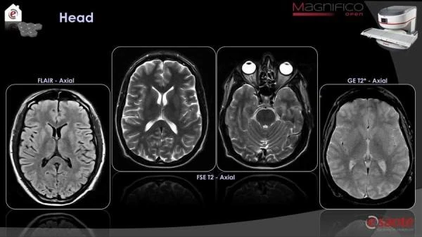 Magnifico yangi avlod MRI tizimi