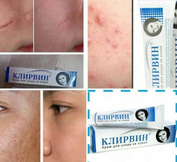 Клирвин крем от прыщей и шрамов