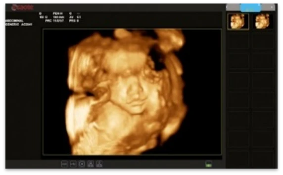 УЗИ аппарат экспертного класса Esaote MyLab X6