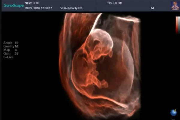 УЗИ аппараты Sonoscape