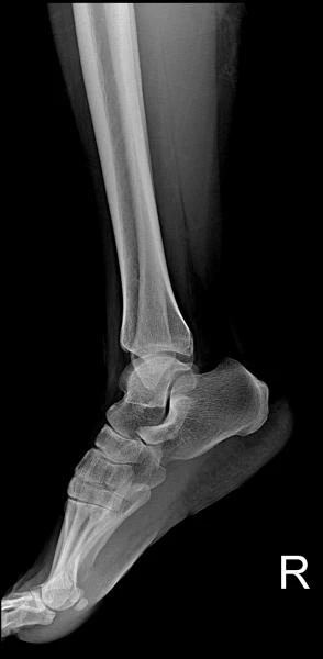 Цифровой рентген аппарат 6600 (56kW Siemens трубка)