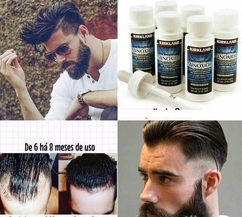 Minoksidil Kirkland 5%