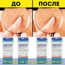 Веррутол (Verrutol) от папиллом
