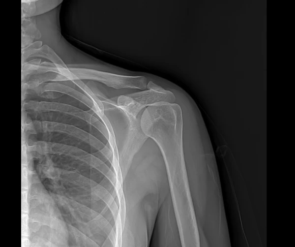 Мобильный рентгеновский аппарат 7200A