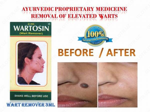 Wartosin - Vartosin (udalenie borodavok)