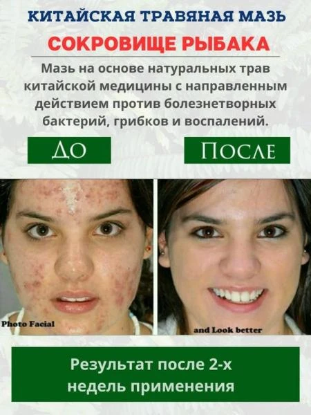 Baliqchining xazinasi malhami-toshbaqa kasalligi, dermatit, liken, qichishish uchun