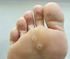 Веррутол (Verrutol) от папиллом