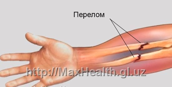 Bandaj dlya plecha i predplechya Sling Sporty