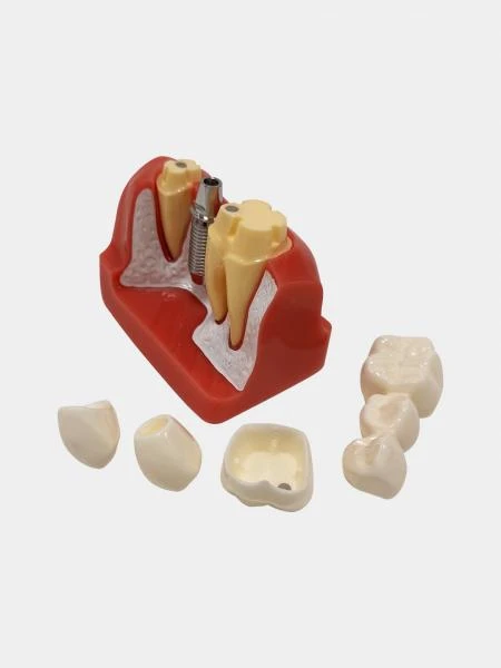 Муляж Implant analysis model with bridge/Модель анализа имплантата с мостом (Розовый)