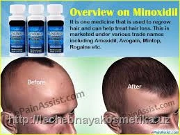 Minoksidil Kirkland 5%