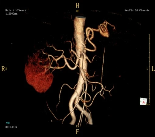Компьютерная томография (КТ) NeuViz 16 Classic