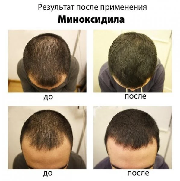 Minoxidil 10% средство для роста волос (Таиланд)
