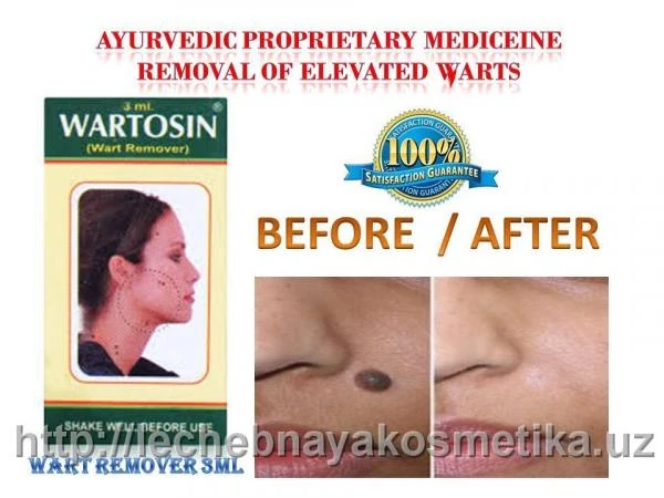 Gel ot papillom Wartosin