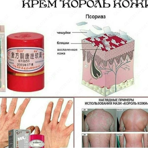 Tayskaya maz "Korol koji" ot psoriaza