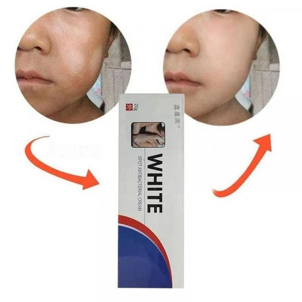 Vitiligo oq dog'lar uchun antibakterial krem