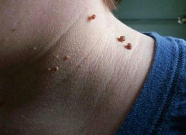 Веррутол (Verrutol) препарат от бородавок и папилом