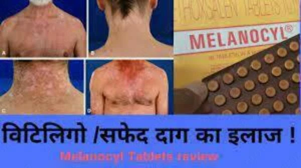 Таблетки от витилиго Меланоцил (Melanocyl)