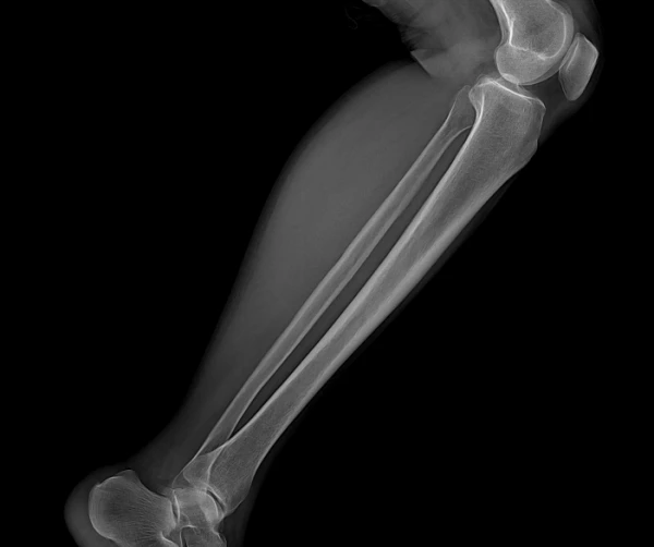 Мобильный рентгеновский аппарат 7200A