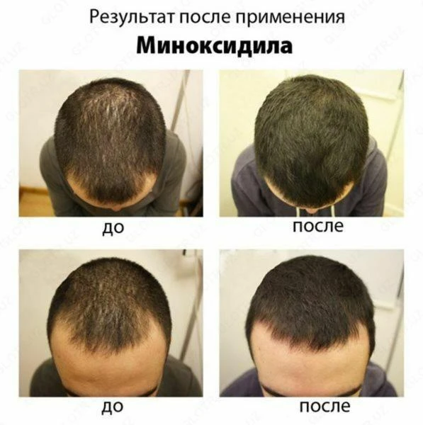 Миноксидил Hair4u 10% (India)