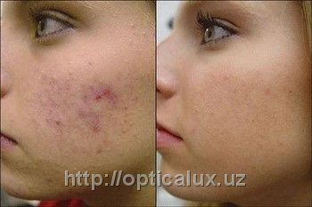 Очищающий пилинг с AHA кислотами