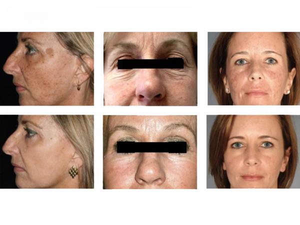 Фракционный CO2 лазер Косметологическии CL1