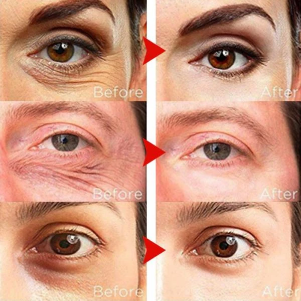 Ajinlarga qarshi nemlendirici kollagenli ko'z kremi 5 ta 1da